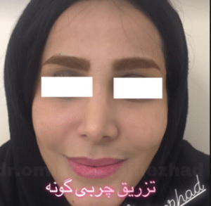 نمونه تزریق چربی دکتر امید یوسف نژاد