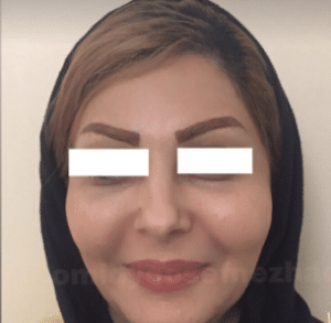 نمونه تزریق چربی دکتر امید یوسف نژاد