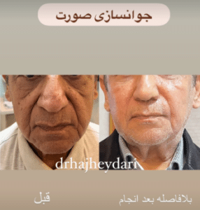 نمونه تزریق چربی دکتر زهره حاج حیدری