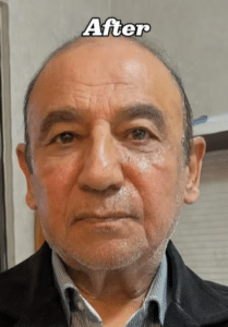 نمونه تزریق چربی دکتر زهره حاج حیدری