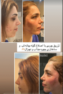 نمونه تزریق چربی دکتر زهره حاج حیدری