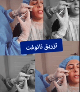 نمونه تزریق چربی دکتر رجا قلیان