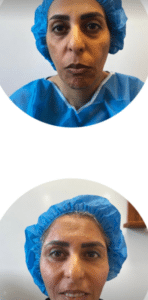 نمونه تزریق چربی دکتر رجا قلیان