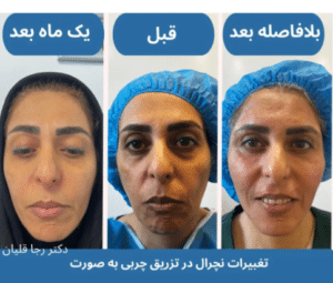 نمونه تزریق چربی دکتر رجا قلیان