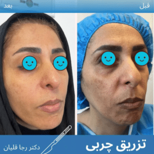 نمونه تزریق چربی دکتر رجا قلیان