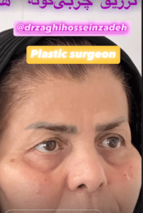 نمونه تطریق چربی دکتر احمد زاغی حسین زاده