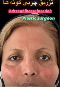 نمونه تطریق چربی دکتر احمد زاغی حسین زاده