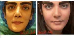 نمونه تزریق چربی دکتر آزاده رضازاده