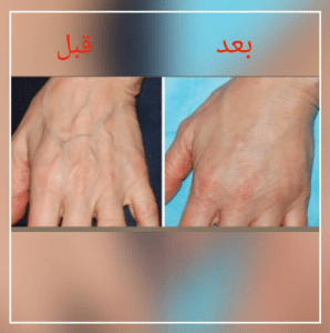 نمونه تزریق چربی دکتر آزاده رضازاده