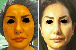 نمونه تزریق چربی دکتر آزاده رضازاده