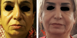 نمونه تزریق چربی دکتر آزاده رضازاده