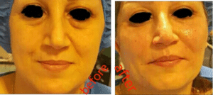 نمونه تزریق چربی دکتر آزاده رضازاده