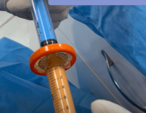 نمونه تزریق چربی دکتر هدی حق نظر