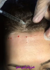 نمونه مزوتراپی برای درمان ریزش مو دکتر قاسم رحمت پور رکنی