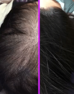 نمونه مزوتراپی برای درمان ریزش مو دکتر قاسم رحمت پور رکنی