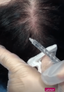 نمونه مزوتراپی برای درمان ریزش مو دکتر قاسم رحمت پور رکنی