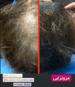 نمونه مزوتراپی برای درمان ریزش مو دکتر قاسم رحمت پور رکنی