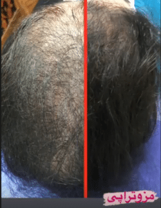 نمونه مزوتراپی برای درمان ریزش مو دکتر قاسم رحمت پور رکنی