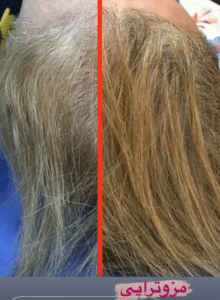 نمونه مزوتراپی برای درمان ریزش مو دکتر قاسم رحمت پور رکنی