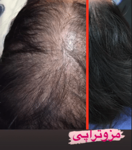نمونه مزوتراپی برای درمان ریزش مو دکتر قاسم رحمت پور رکنی