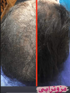 نمونه مزوتراپی برای درمان ریزش مو دکتر قاسم رحمت پور رکنی