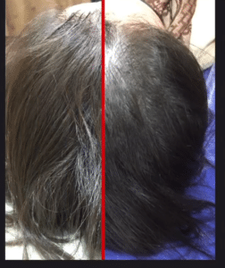 نمونه مزوتراپی برای درمان ریزش مو دکتر قاسم رحمت پور رکنی