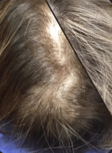 نمونه مزوتراپی برای درمان ریزش مو دکتر قاسم رحمت پور رکنی