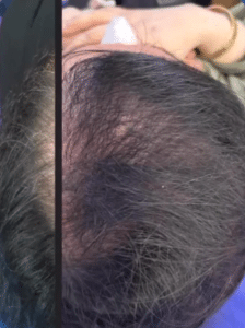 نمونه مزوتراپی برای درمان ریزش مو دکتر قاسم رحمت پور رکنی