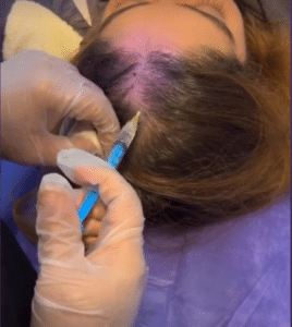 نمونه مزوتراپی برای درمان ریزش مو دکتر قاسم رحمت پور رکنی