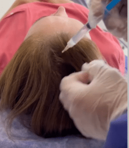 نمونه مزوتراپی برای درمان ریزش مو دکتر قاسم رحمت پور رکنی