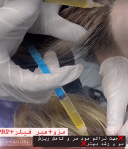نمونه مزوتراپی برای درمان ریزش مو دکتر قاسم رحمت پور رکنی