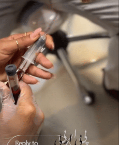 نمونه درمان ریزش مو با prp دکتر محمود جعفری