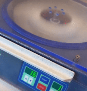 نمونه درمان ریزش مو با prp دکتر محمود جعفری