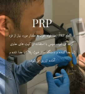 نمونه درمان ریزش مو با prp دکتر محمود جعفری
