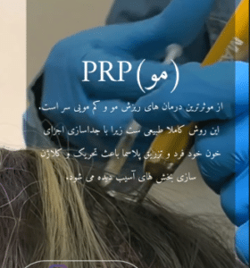 نمونه درمان ریزش مو با prp دکتر محمود جعفری