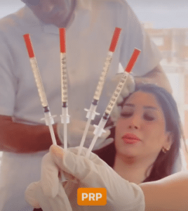 نمونه درمان ریزش مو با prp دکتر محمود جعفری