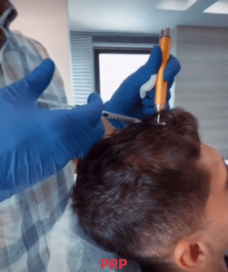 نمونه درمان ریزش مو با prp دکتر محمود جعفری