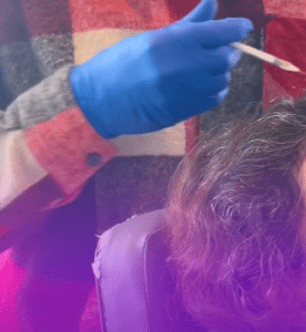 نمونه درمان ریزش مو با prp دکتر محمود جعفری