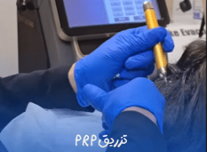 نمونه درمان ریزش مو با prp دکتر محمود جعفری
