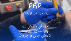 نمونه درمان ریزش مو با prp دکتر محمود جعفری