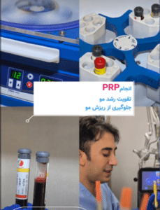 نمونه درمان ریزش مو با prp دکتر محمود جعفری