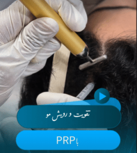 نمونه درمان ریزش مو با prp دکتر محمود جعفری