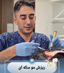 نمونه درمان ریزش مو سکه ای با prp دکتر محمود جعفری