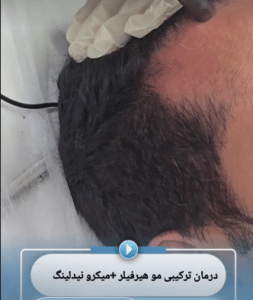نمونه درمان ریزش مو با درمان های ترکیبی دکتر محمود جعفری