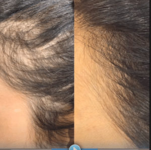 نمونه درمان ریزش مو با درمان های ترکیبی دکتر محمود جعفری