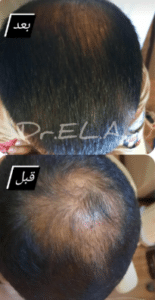 نمونه درمان ریزش مو با مزوتراپی مو دکتر المیرا اسدی