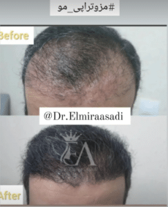 نمونه درمان ریزش مو با مزوتراپی مو دکتر المیرا اسدی