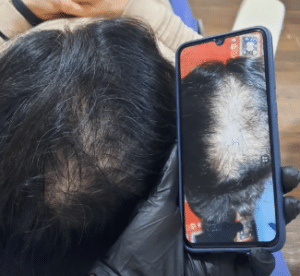 نمونه درمان ریزش مو با مزوتراپی مو دکتر المیرا اسدی