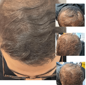 نمونه درمان ریزش مو به روش prp دکتر زهره حاج حیدری