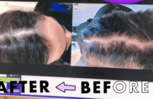 نمونه درمان ریزش مو دکتر زهره حاج حیدری